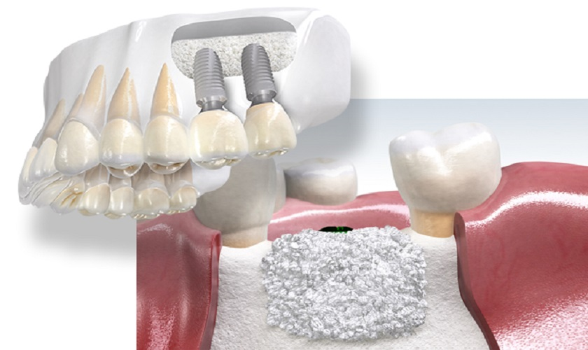 Tăng thể tích xương & Đặt Implant đồng thời